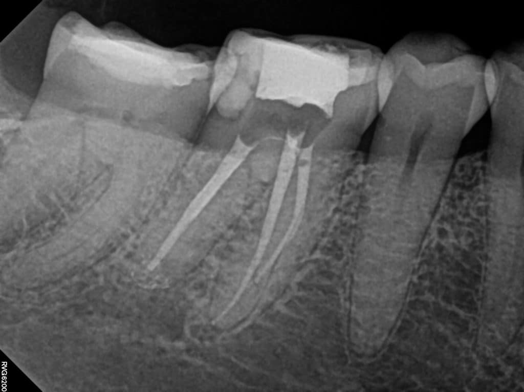 Final x-ray when you need root canal