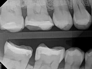 xray of teeth after fillings