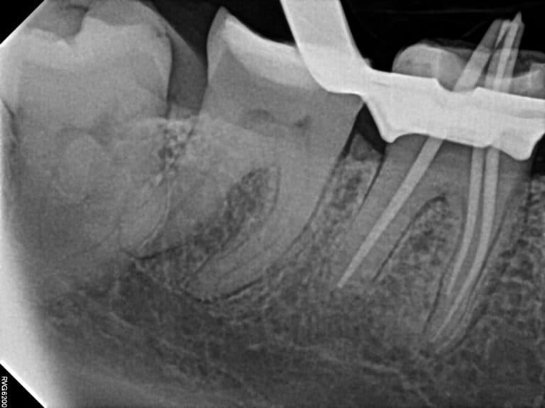 X-ray during root canal